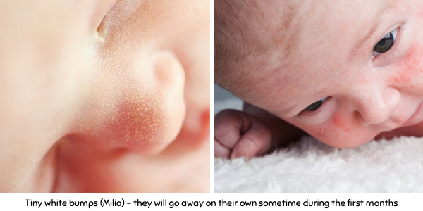 Milia newborn skin 